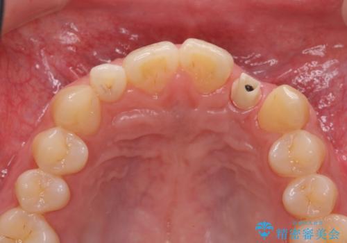 前歯部 インプラント治療の治療中
