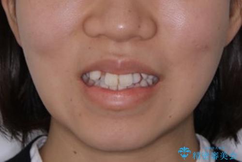 インビザライン単独での抜歯矯正治療の治療前(顔貌)