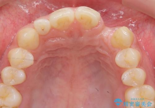 前歯部 インプラント治療の治療前