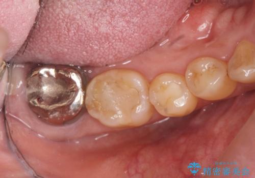 歯周病に対する全体治療の治療前