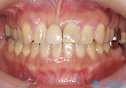 歯周病に対する全体治療の症例 治療前