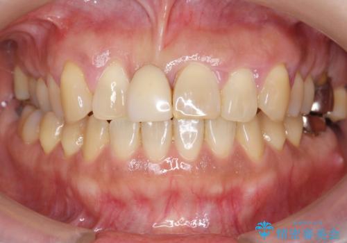 歯周病に対する全体治療の症例 治療前