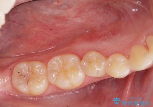 マウスピース矯正前に行う骨隆起の除去の治療後