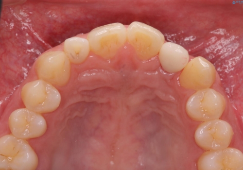 前歯部 インプラント治療の治療後