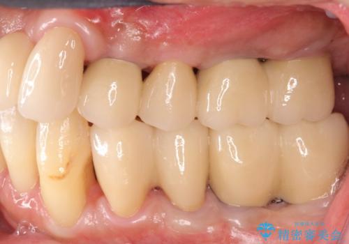 [ 重度歯周病 ] 骨造成・インプラント治療による咬合機能の回復の症例 治療後