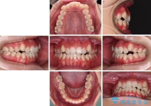 【モニター】上顎が狭い 急速拡大装置を用いたデコボコの解消の治療前