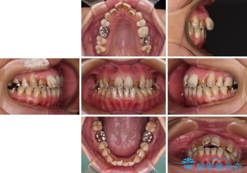 前歯の後戻り インビザラインでの再矯正治療の治療前