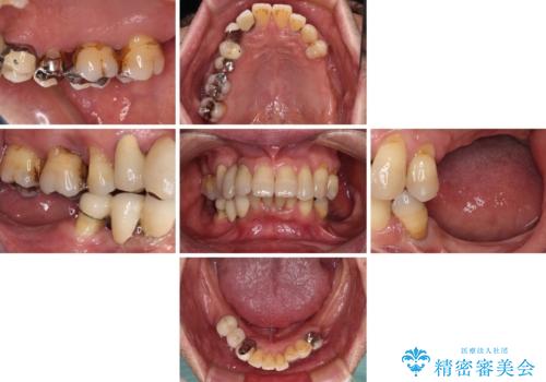 装着感の良い入れ歯を作りたい　金属床を使用した適合の良い部分床義歯の治療前