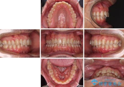 【モニター】前歯のデコボコを治したい インビザライン矯正治療の治療前