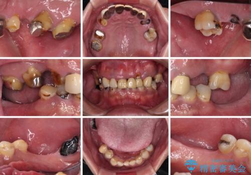 欠損と虫歯だらけの口の中 真っ白なセラミック治療の治療前