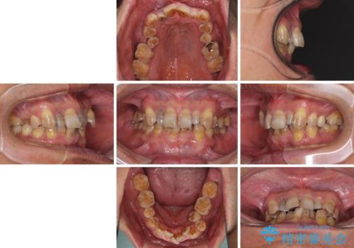 左右に骨格がずれて咬みにくい ワイヤー装置による抜歯矯正の治療前