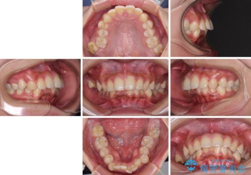 深い咬み合わせと前歯のデコボコ　インビザラインによる矯正治療の治療前