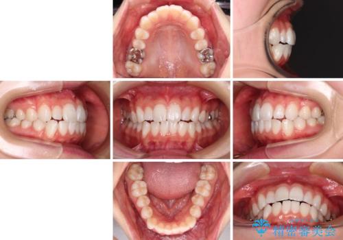 【モニター】口が閉じにくい 膨らんだ口元を抜歯矯正ですっきりとの治療前
