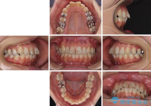 【モニター】前歯のデコボコを治したい インビザラインを用いた矯正治療の治療前
