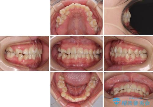 重度叢生と埋もれた奥歯 8本を抜歯したワイヤー矯正の治療前