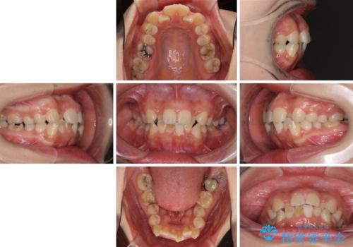 デコボコと膨らんだ口元 ハーフリンガルによる抜歯矯正とインプラント補綴治療の治療前