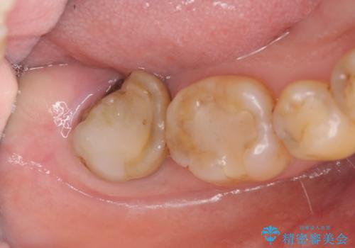 歯周病に対する全体治療の治療中