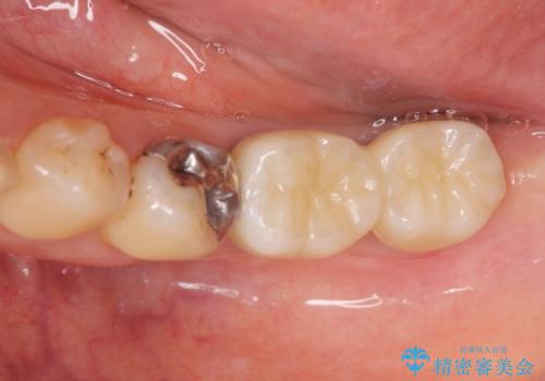 歯周病に対する全体治療の治療後