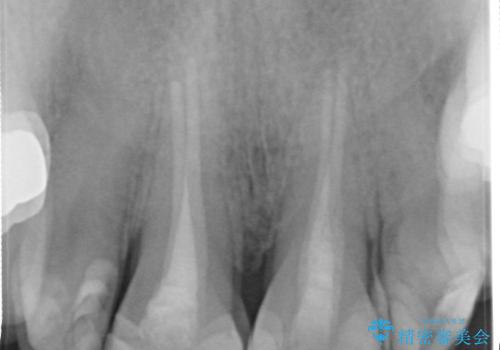 前歯の着色が気になる(失活歯)の治療前