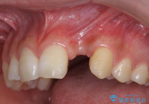前歯部 インプラント治療の症例 治療前