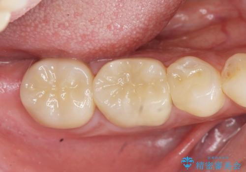 「 セラミック治療 」奥歯を白くしたいの治療後