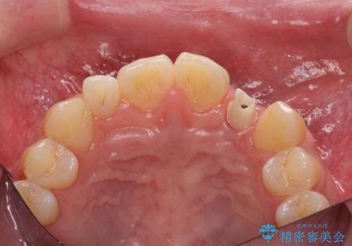 前歯部 インプラント治療の治療中