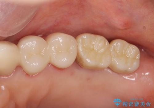 歯周病に対する全体治療の治療後