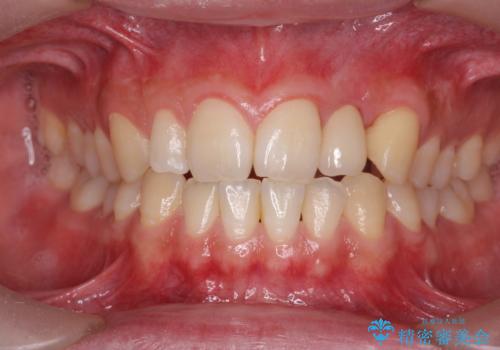 前歯部 インプラント治療の治療後