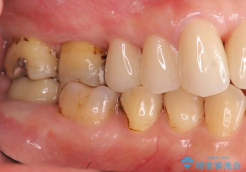 歯周病に対する全体治療の治療後