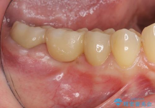 銀歯の下に大きな虫歯の再発の治療後