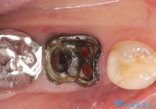 銀歯の下に大きな虫歯の再発