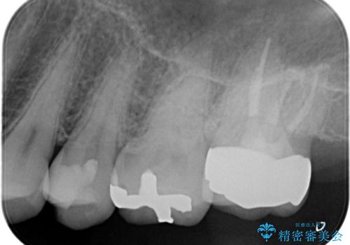【セラミックインレー】虫歯の治療の治療前