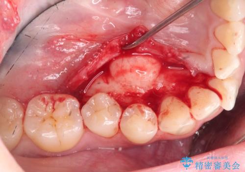 マウスピース矯正前に行う骨隆起の除去の治療中
