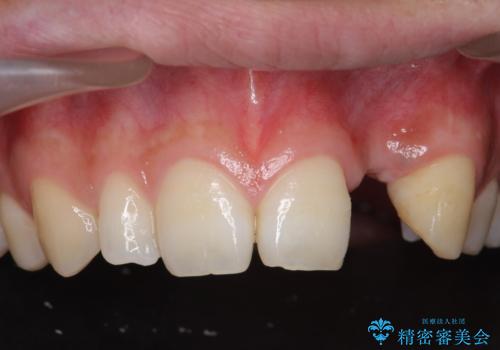 前歯部 インプラント治療の治療前
