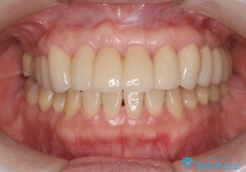 歯周病に対する全体治療の症例 治療後