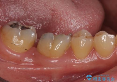 銀歯が取れた セラミックでのやり替えの治療前