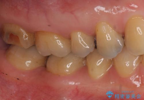 銀歯が取れた セラミックでのやり替えの治療前