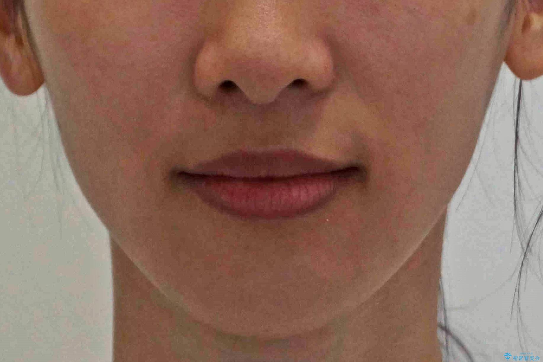 親知らずを生かした矯正の治療後(顔貌)