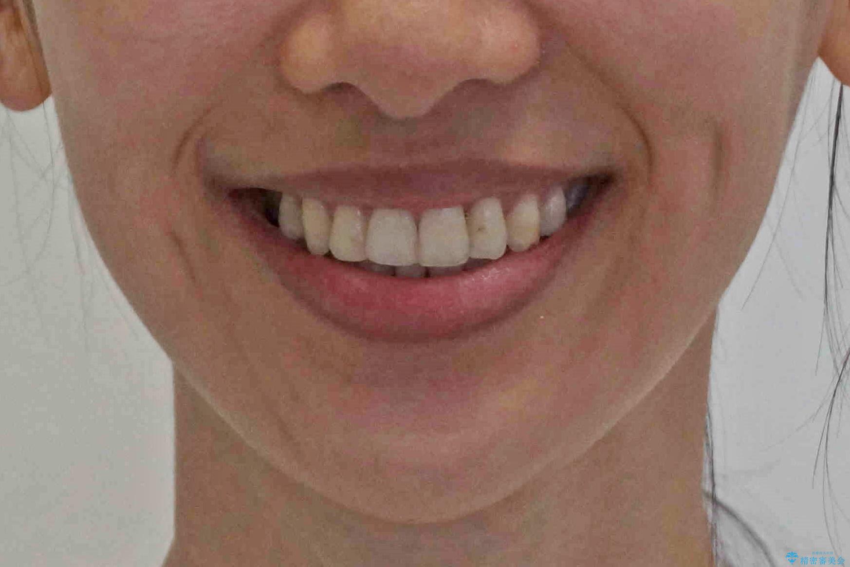 親知らずを生かした矯正の治療後(顔貌)