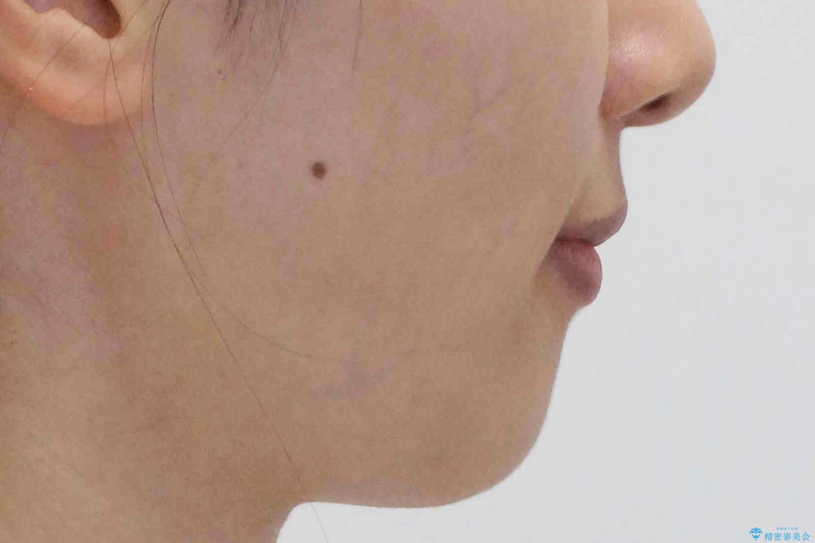 親知らずを生かした矯正の治療後(顔貌)