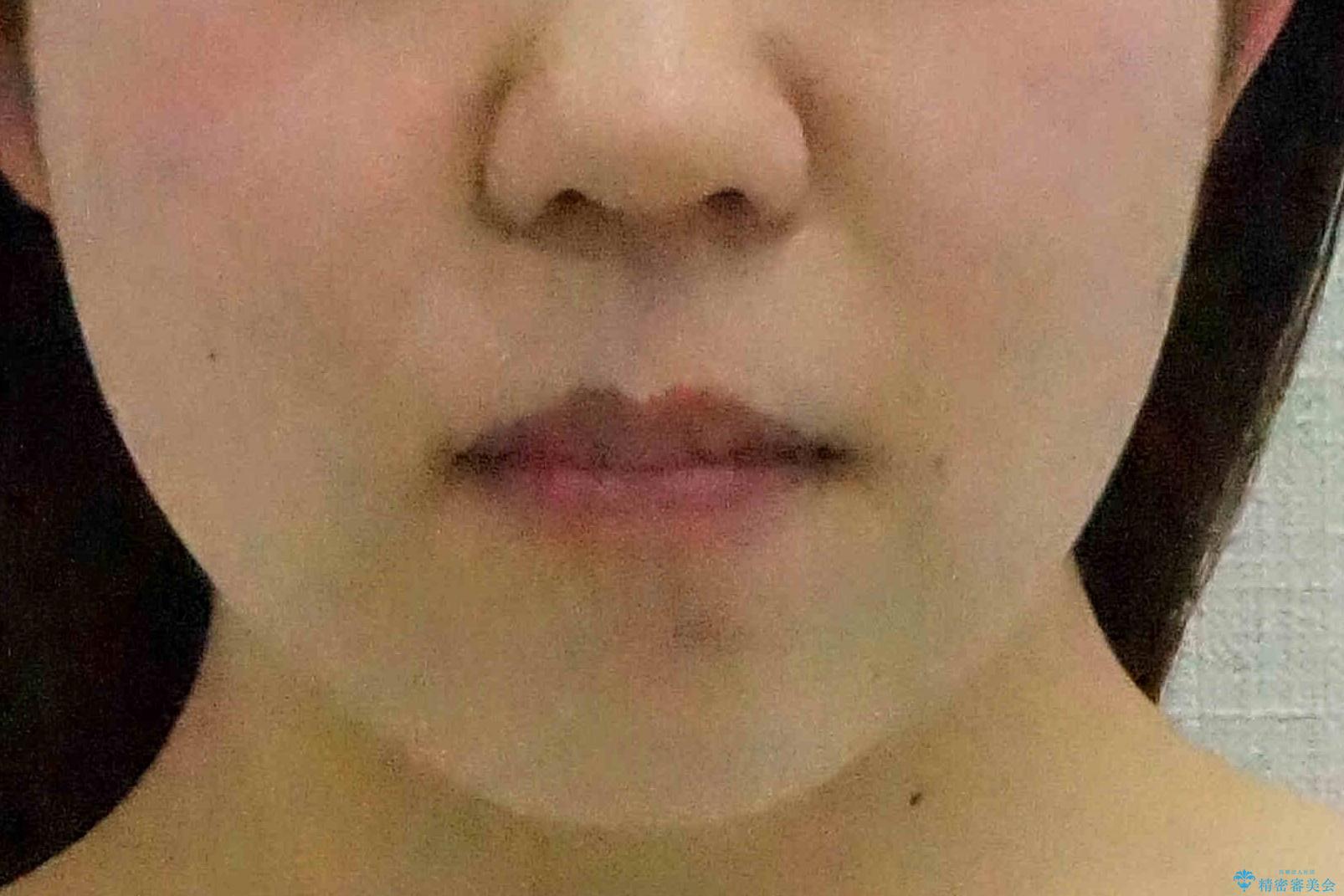 かみ合わせが悪いところを ワイヤー矯正でしっかり治療 マウスピース矯正は難しい症例の治療後(顔貌)