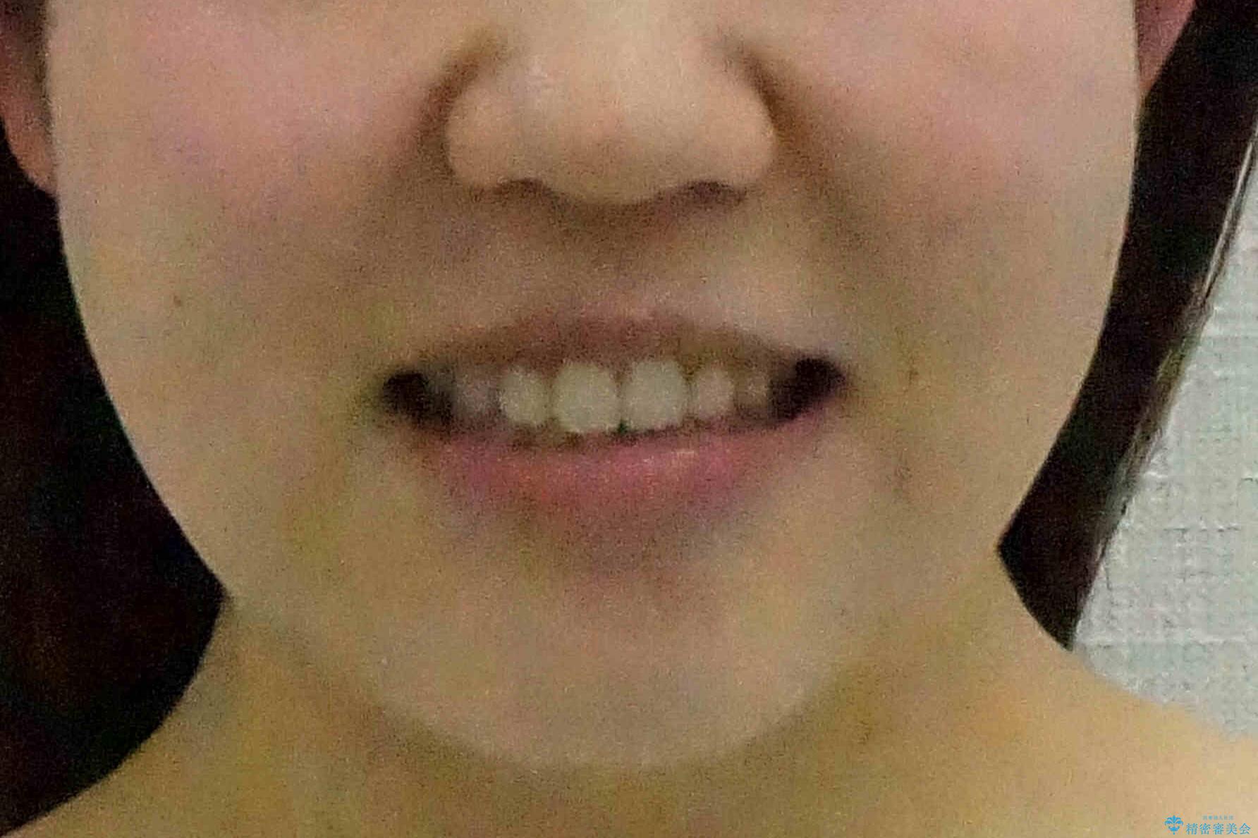 かみ合わせが悪いところを ワイヤー矯正でしっかり治療 マウスピース矯正は難しい症例の治療後(顔貌)