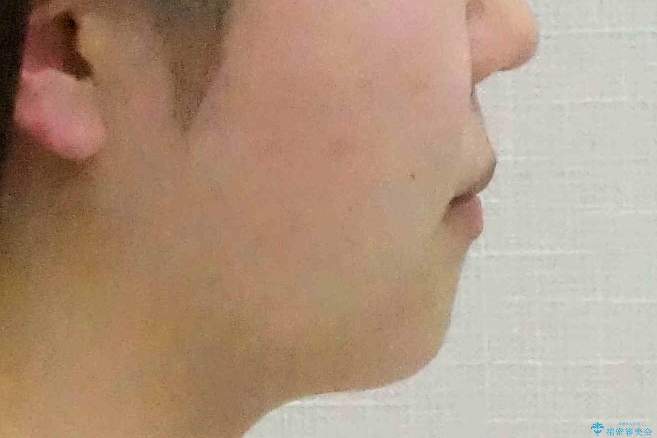 かみ合わせが悪いところを ワイヤー矯正でしっかり治療 マウスピース矯正は難しい症例の治療後(顔貌)