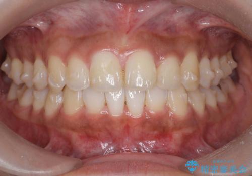 出っ歯感のある前歯を治したい、抜歯をしないマウスピース矯正の治療中