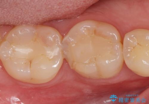 詰め物が欠けてしみる