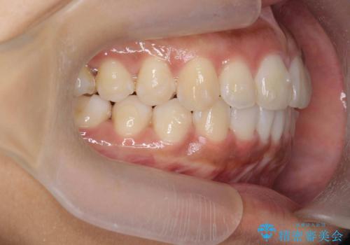 出っ歯感のある前歯を治したい、抜歯をしないマウスピース矯正の治療中