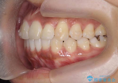 出っ歯感のある前歯を治したい、抜歯をしないマウスピース矯正の治療中