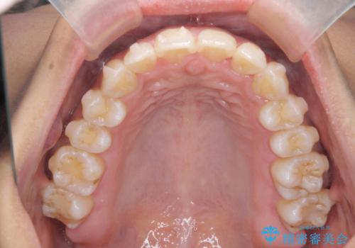 出っ歯感のある前歯を治したい、抜歯をしないマウスピース矯正の治療中