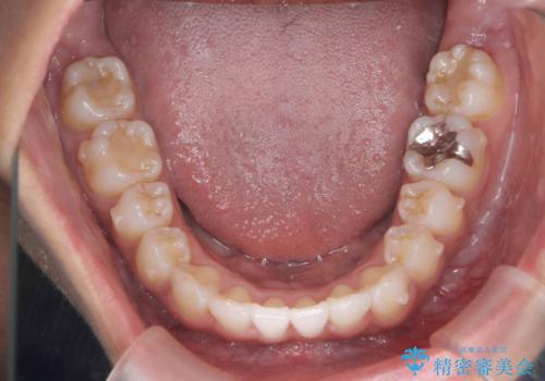 出っ歯感のある前歯を治したい、抜歯をしないマウスピース矯正の治療中