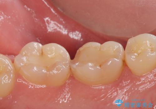 詰め物が欠けてしみるの治療前